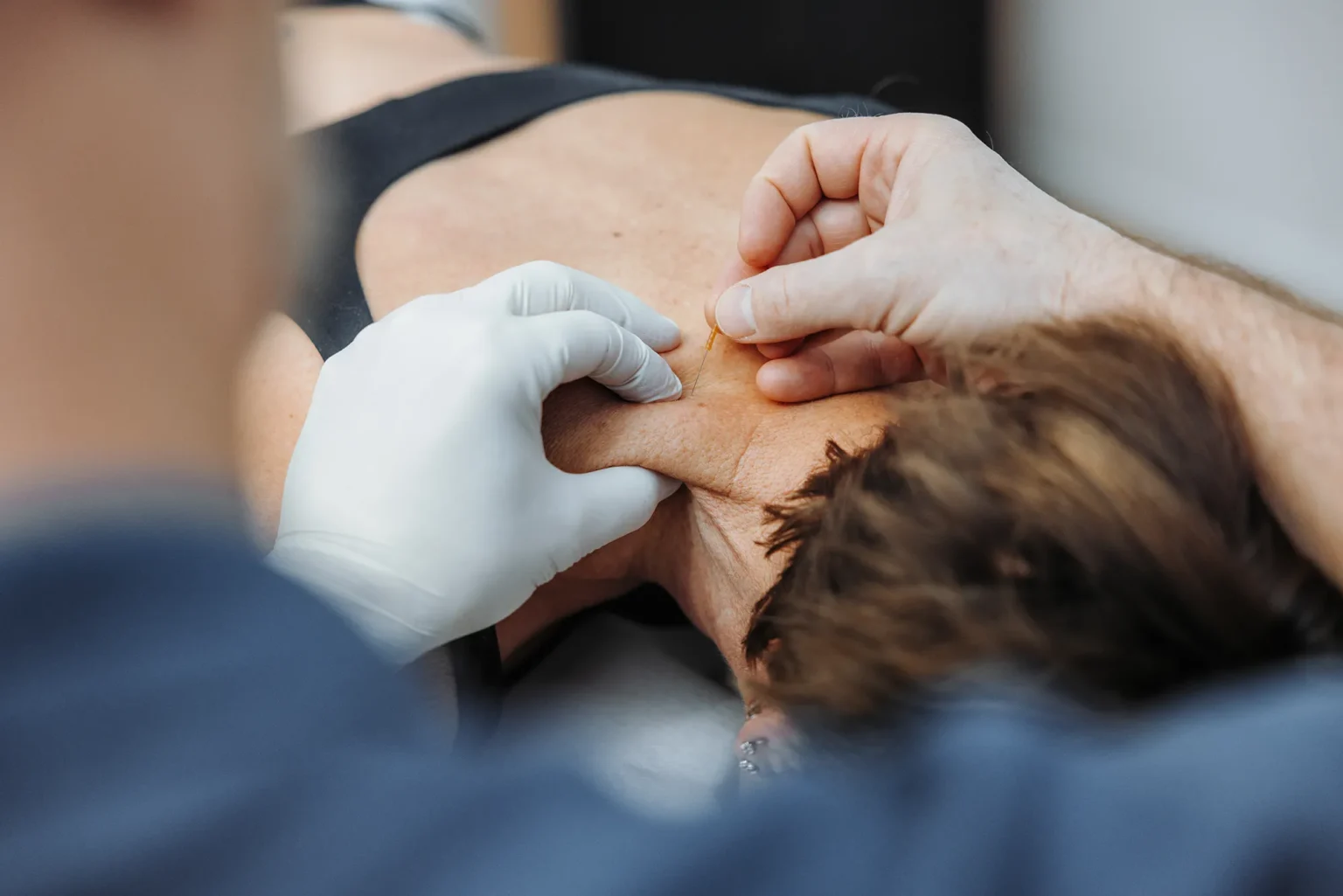 Dry Needling Behandlung mit einer dünnen, sterilen Einweg-Akupunkturnadel in den Triggerpunkt, Gesundheitspraxis Löwen Center in Luzern